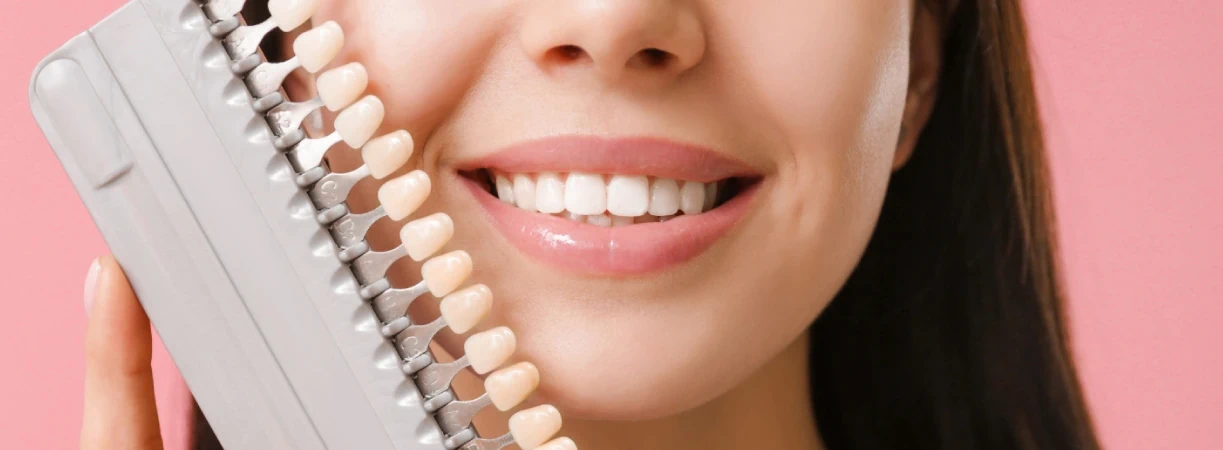 Veneers