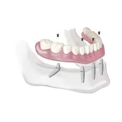 Full Mouth Same Day Dental Implants: Life-Changing Solutions for Denture Wearers