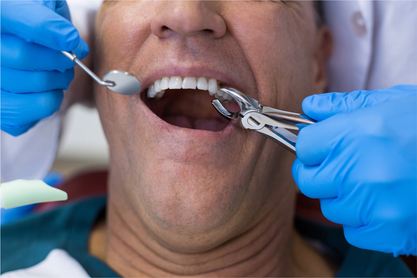 Tooth Extraction Is a Common General Dentistry Procedure