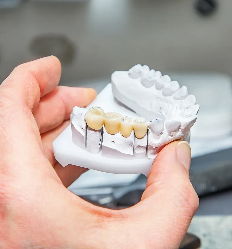 Are Dental Bridges Worth It: Here’s What You Need to Know