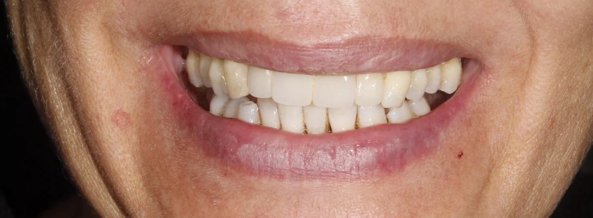 Dental Implants