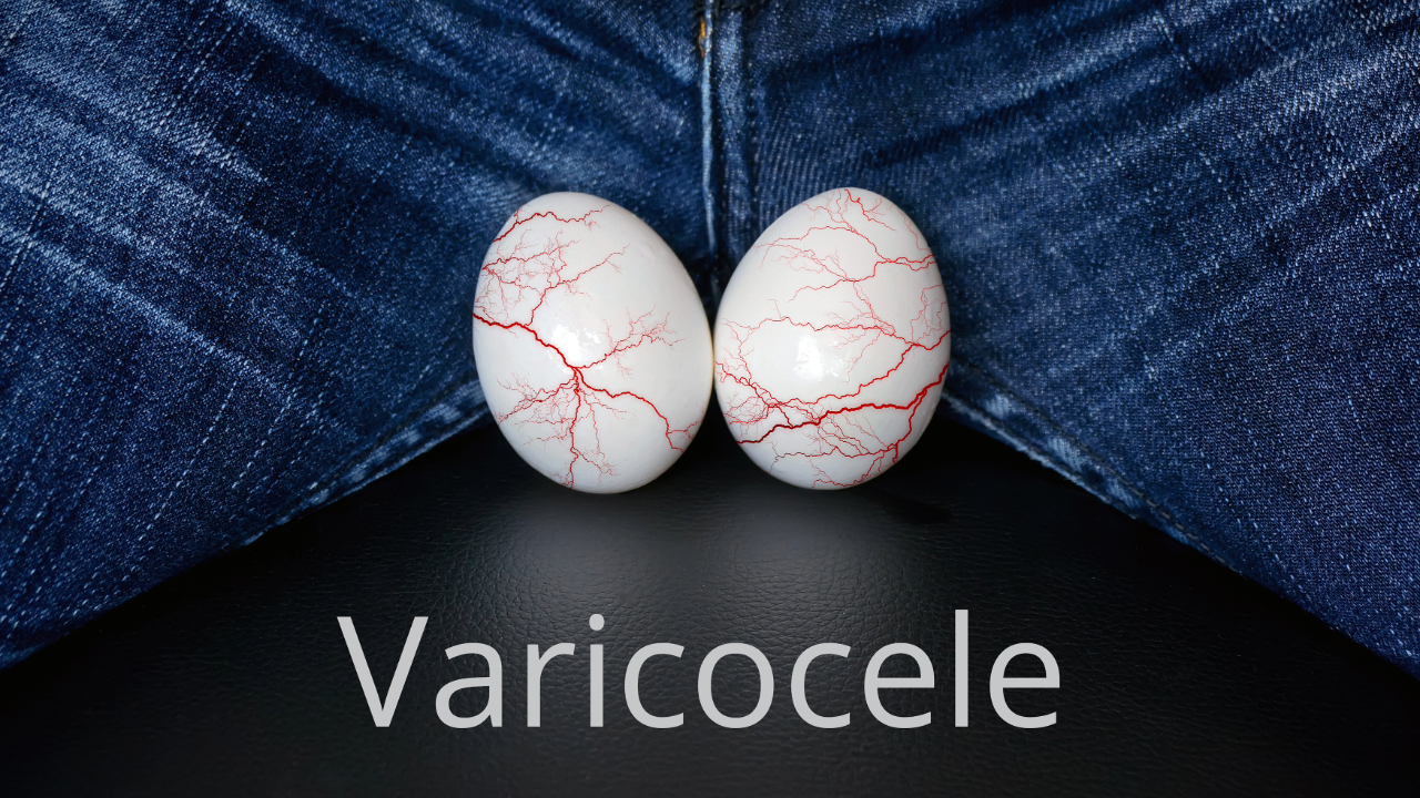 Varicocele and Male Infertility: What You Should Know