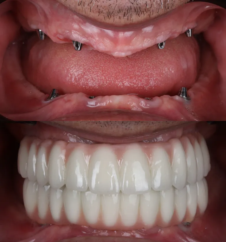 Is An Implant-Retained Denture Right For You?