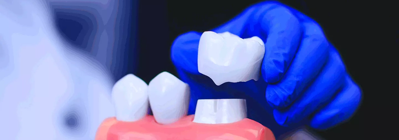 Dental Crowns
