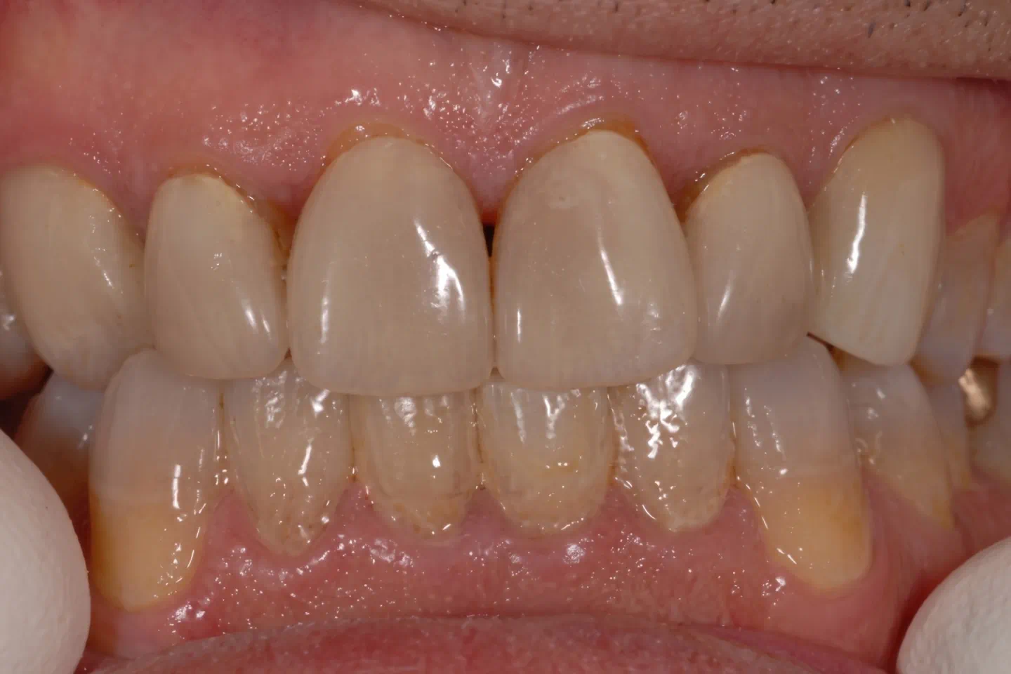 Stained and uneven teeth before veneers