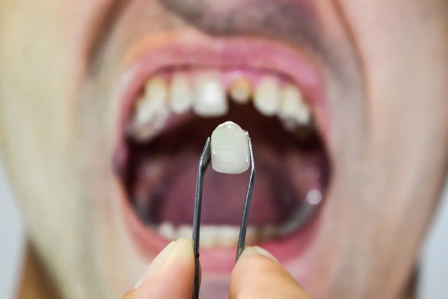 Dental Implants in Lathrop, CA