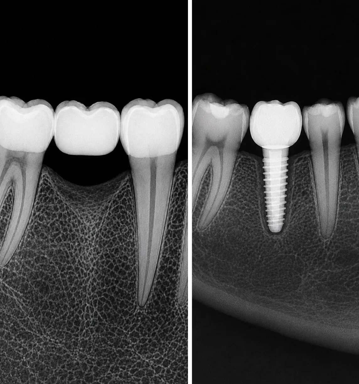 Single tooth implant