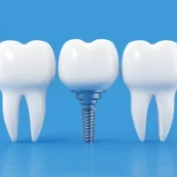 How Long Does a Dental Implant Last?