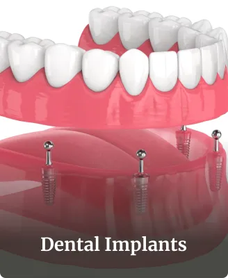 How Long Do Dental Implants Last? Maintenance Tips for a Lifetime Smile