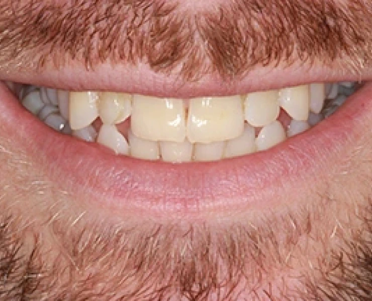 Porcelain Veneers 1