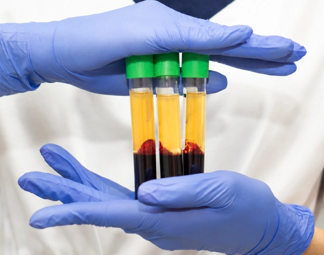 PRP(Platelet Rich Plasma)