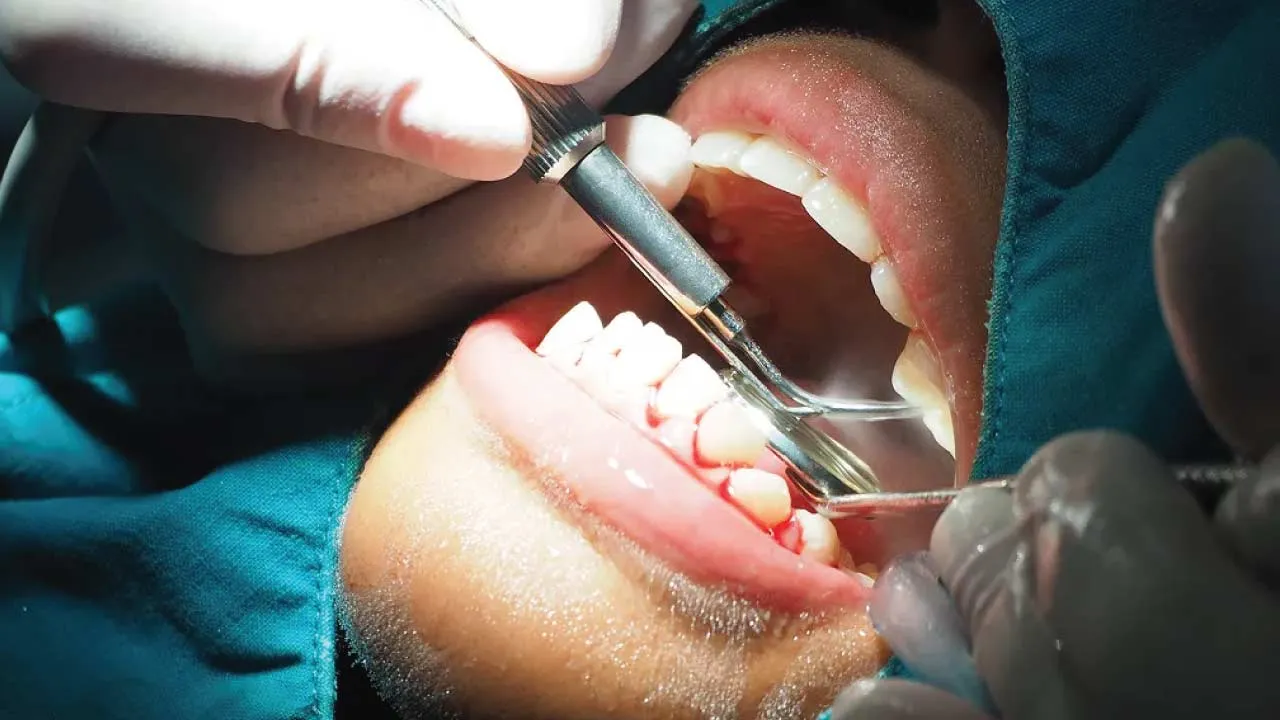 scaling and root planing gum treatment diagram
