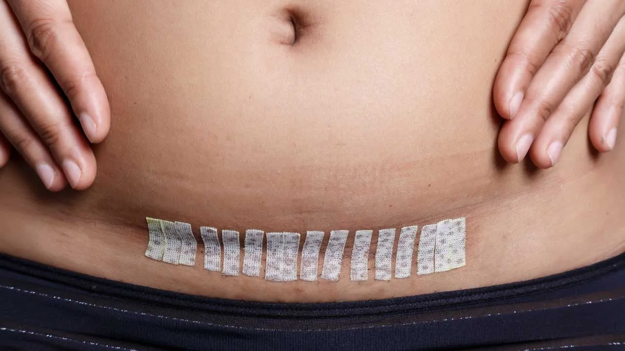 Gynecologist counseling a woman about recovery and lifestyle after hysterectomy surgery