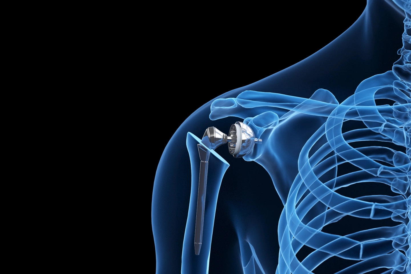 Shoulder Replacement