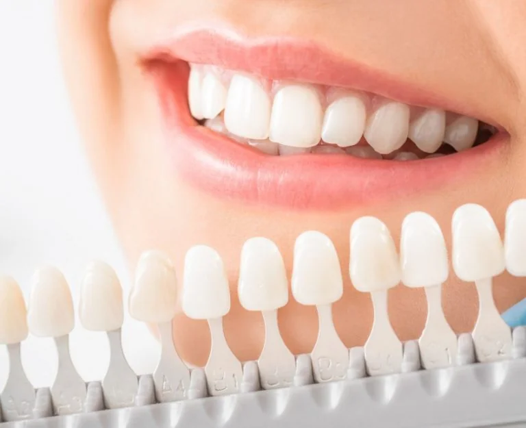 Dental Crowns vs Veneers