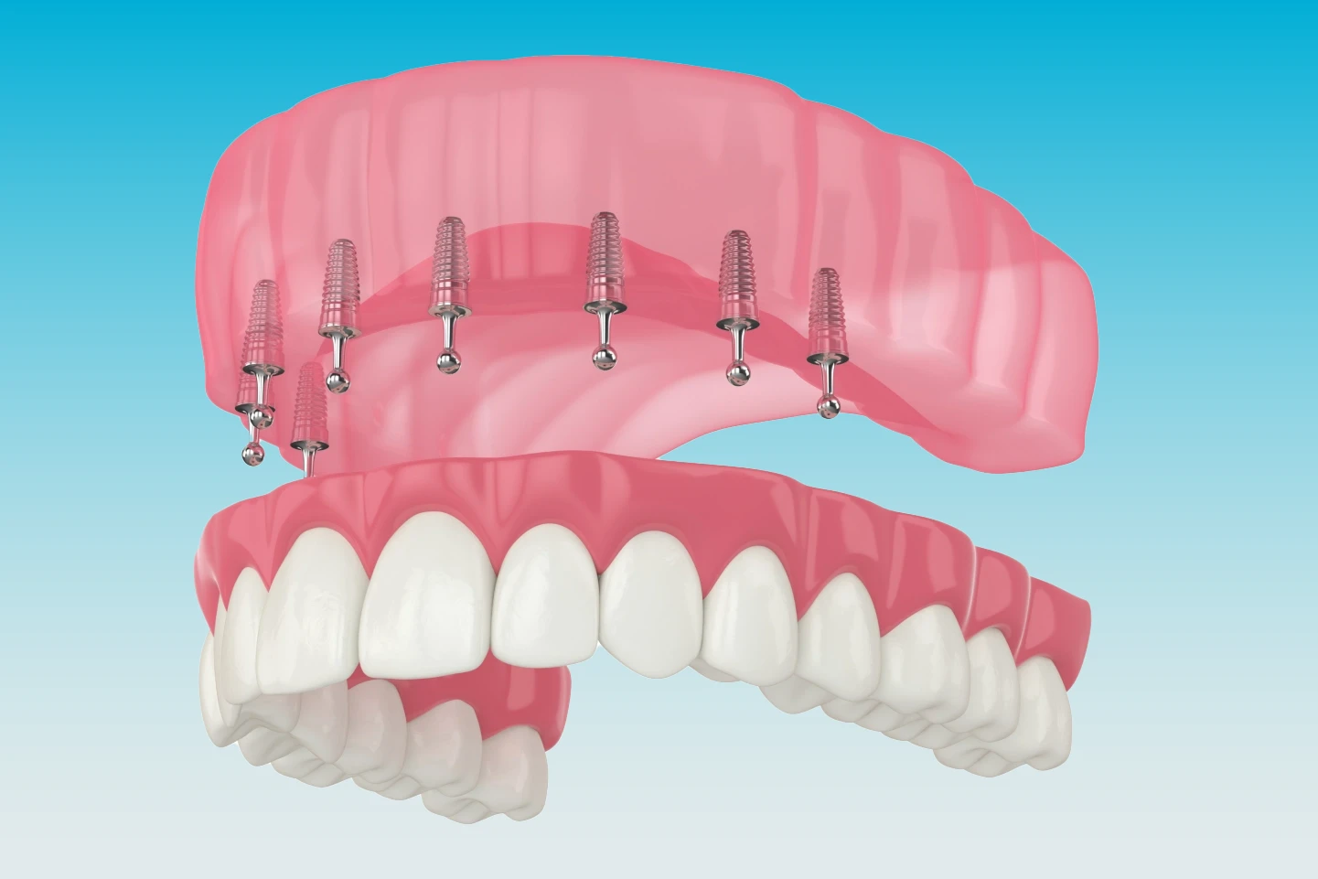 Fixed dentures image