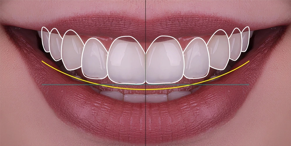 Digital Smile Design