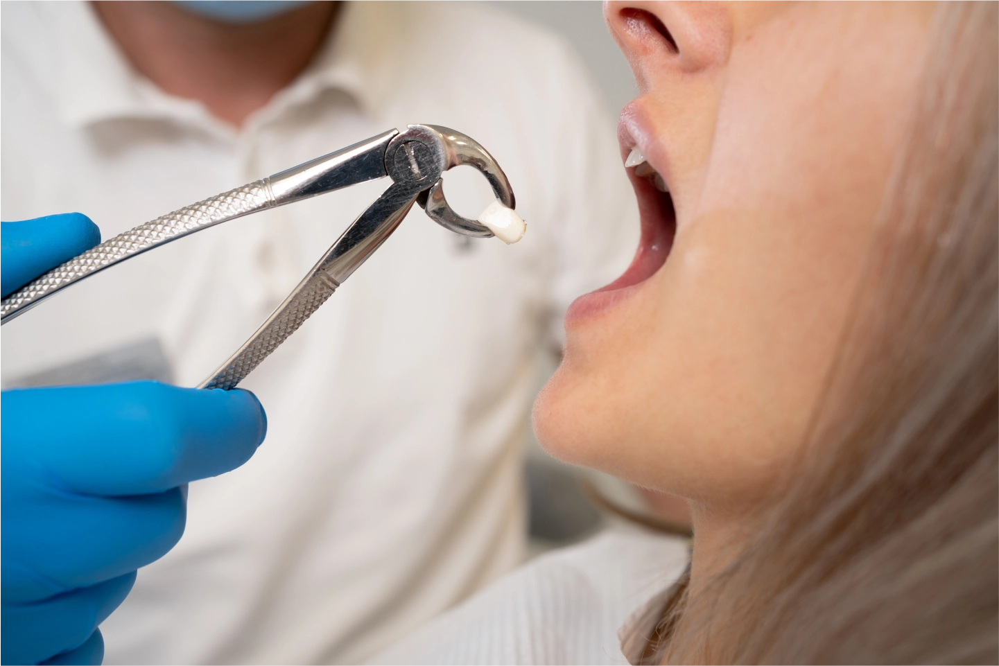 Teeth Extractions