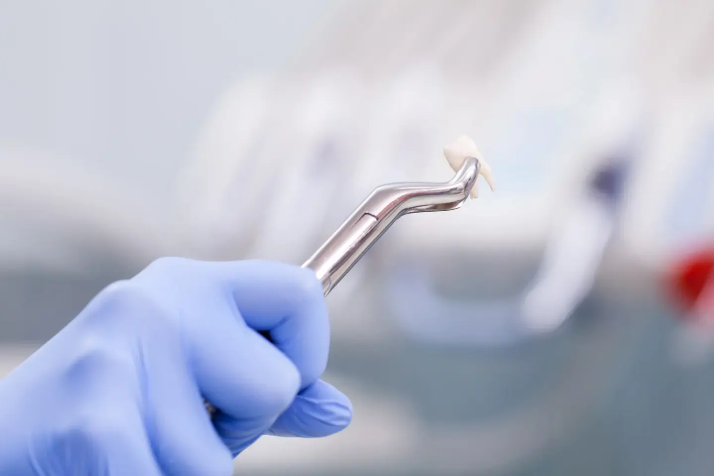 tooth extraction