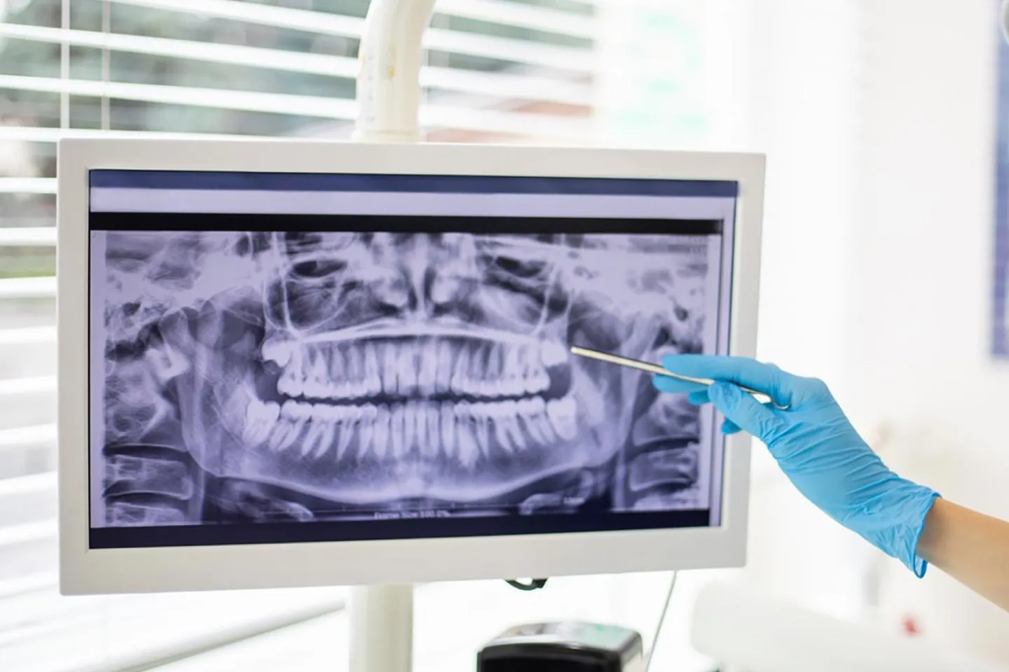 Digital workflow showing AI planning CBCT analysis and virtual implant simulation