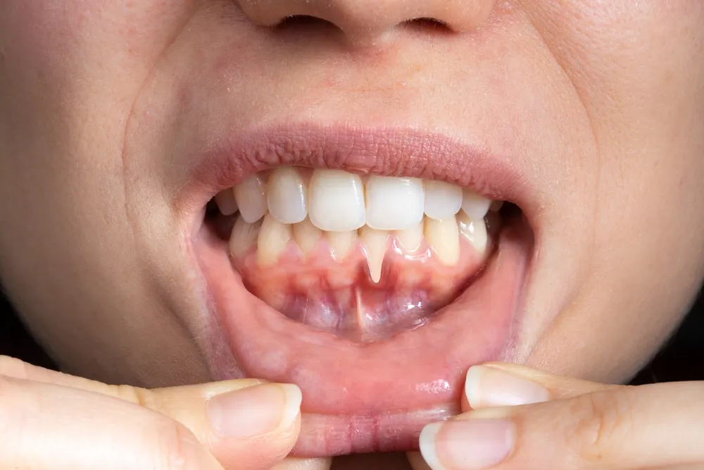 Receding Gums: Causes, Treatments & Prevention | Parkway Smiles Dentistry