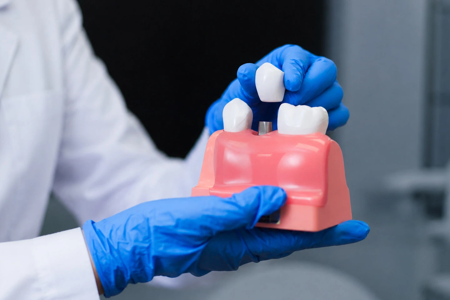 How Long Do Dental Crowns Last?