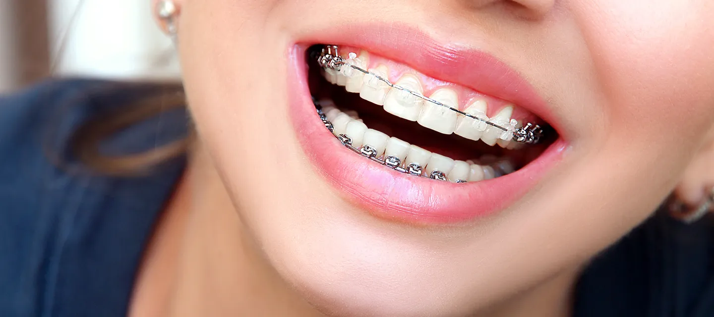 Life with Braces: Tips for a Smooth Journey from Your Southbridge Dental Experts