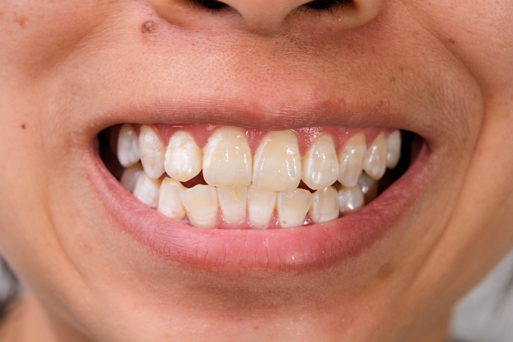 White Spots on Teeth