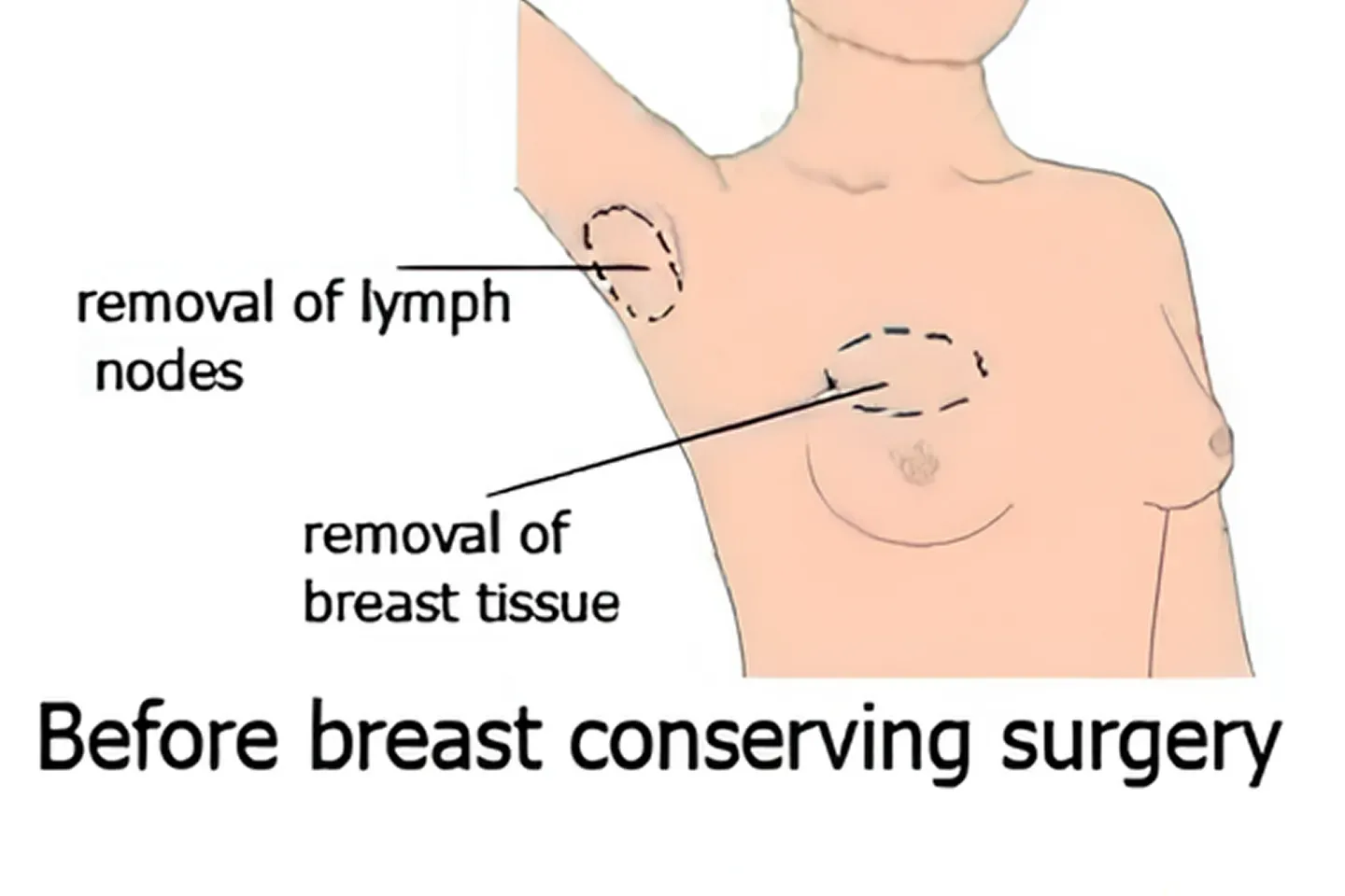 Wide Local Excision illustrative image