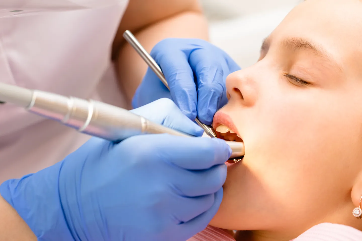 Dental Sealants