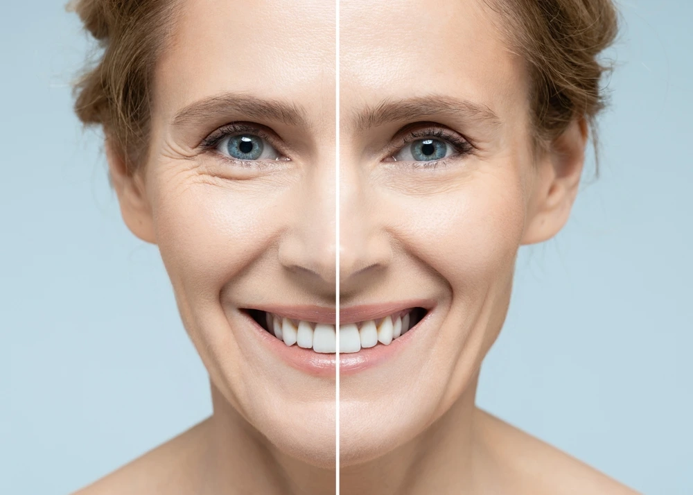 Fillers Facial Rejuvenation