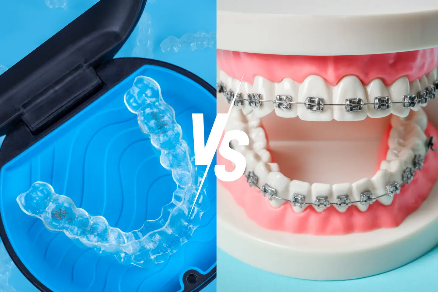 Invisalign® vs. Traditional Braces