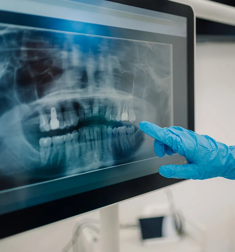 Implant Supported Dentures Model
