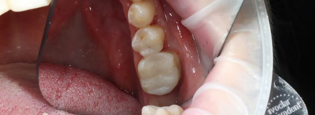White Fillings