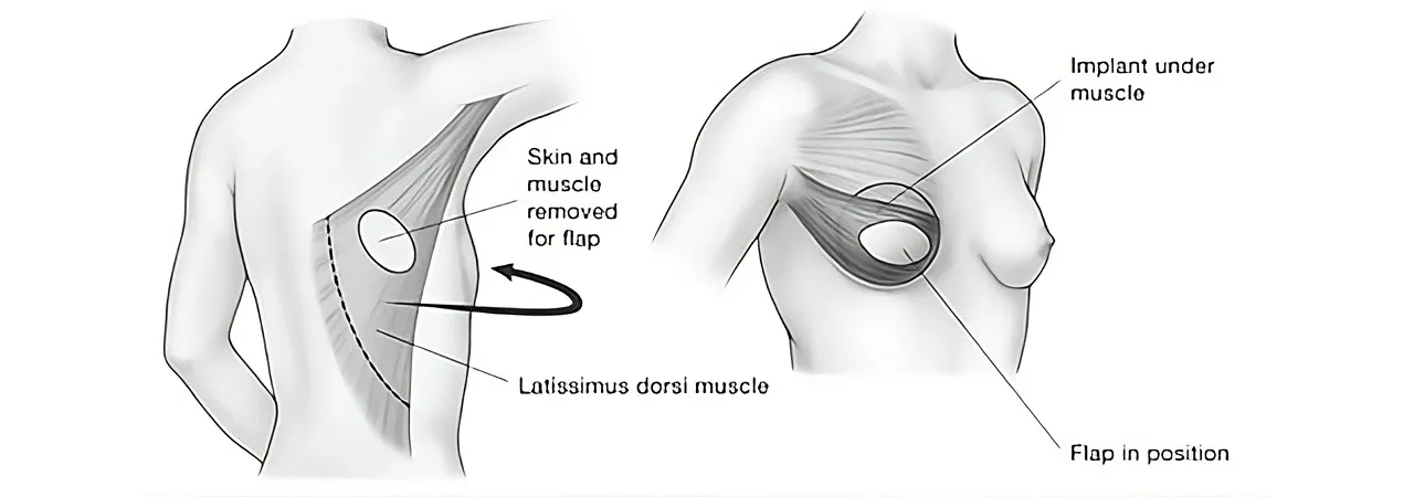 LD Flap Reconstruction