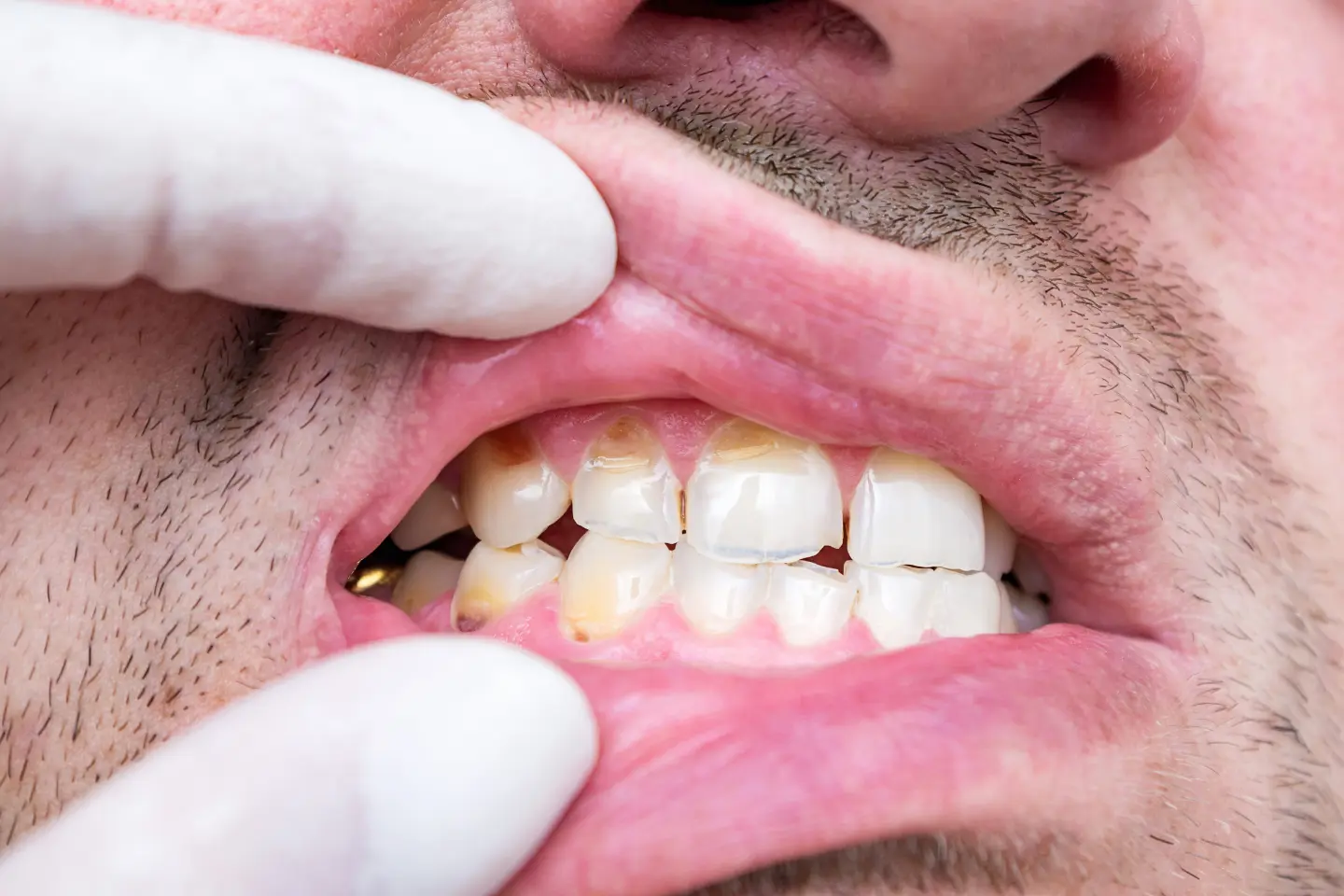 Cracked tooth caused by nighttime teeth grinding.