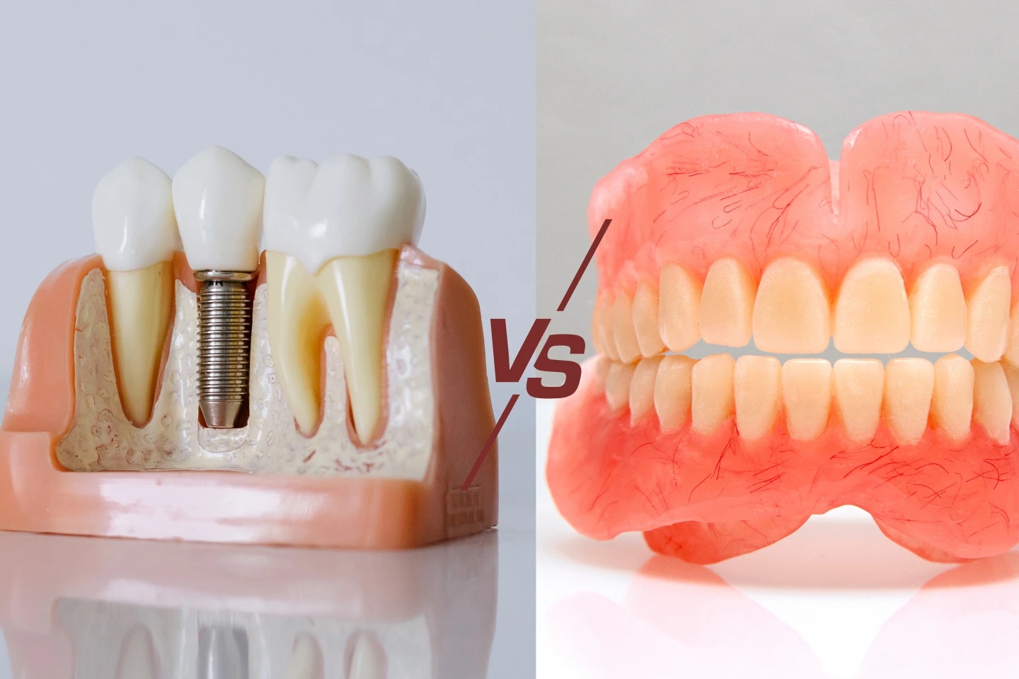 Dental implant vs dentures model showing tooth replacement options.