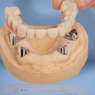 Telescopic dentures
