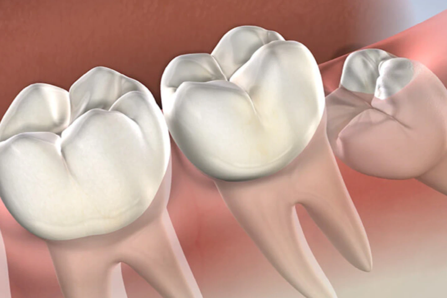Root Canal Treatment Illustration