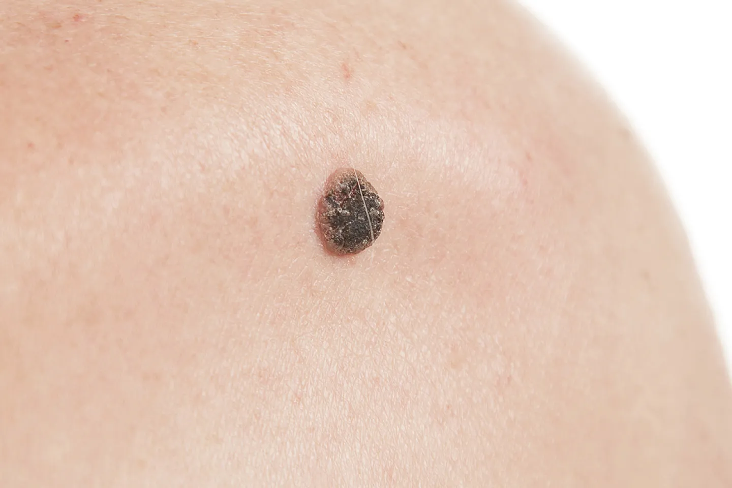 A close up of problem with basal cell carcinoma