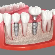 Are dental implants right for you? An honest East Midlands guide before you commit