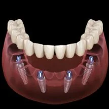All on 4, Implant Dentures or Dentures? Your Complete Guide — Leicester & Corby (2026)