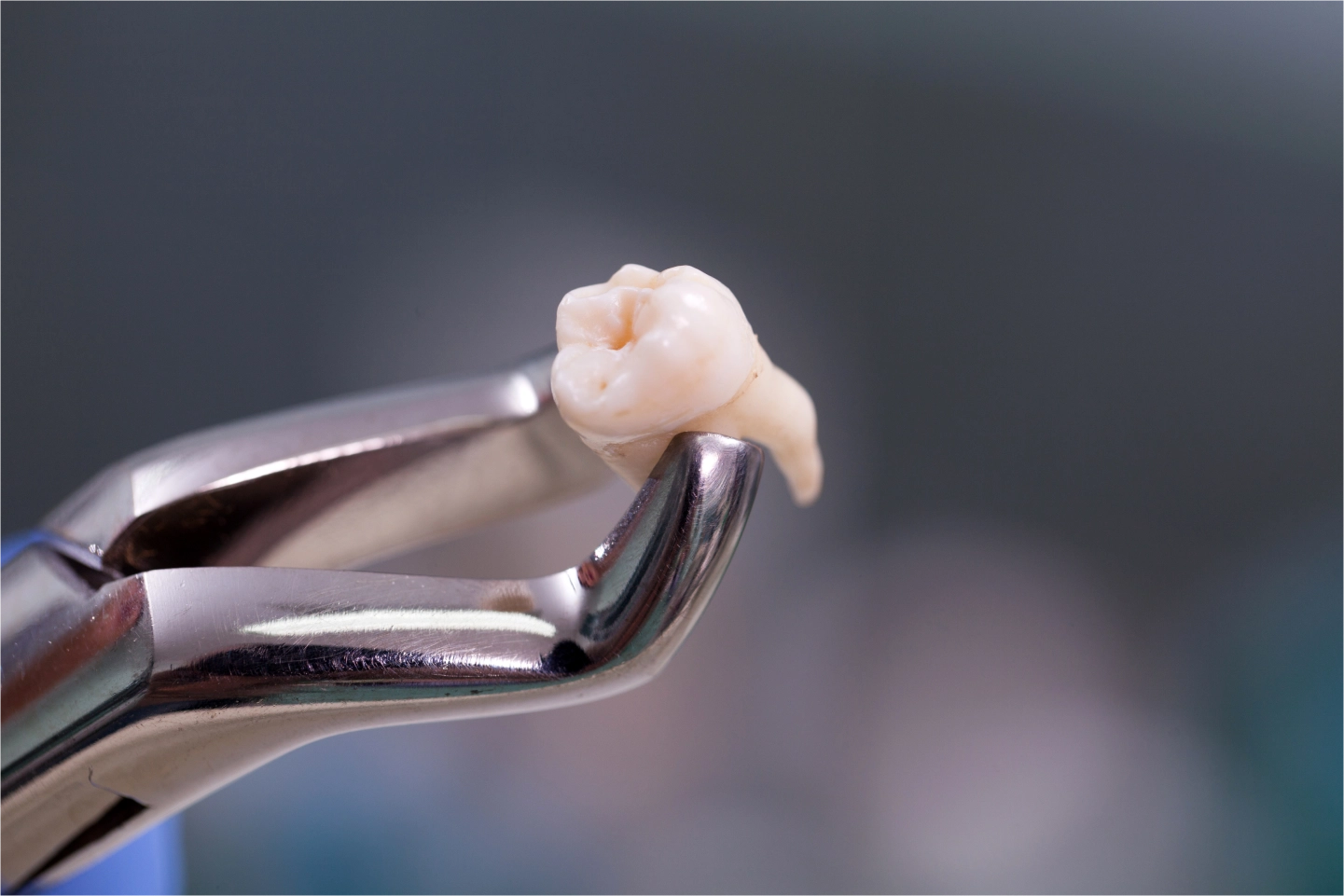 When to Have Wisdom Tooth Removal