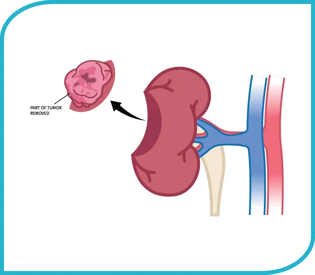 Laparoscopic Partial Nephrectomy