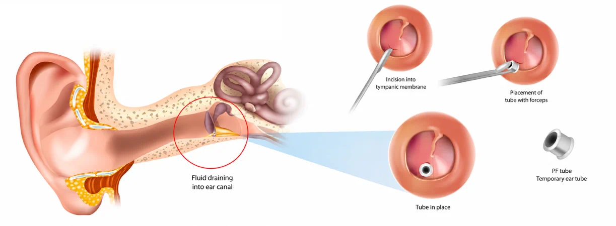 Myringotomy with Grommet Insertion