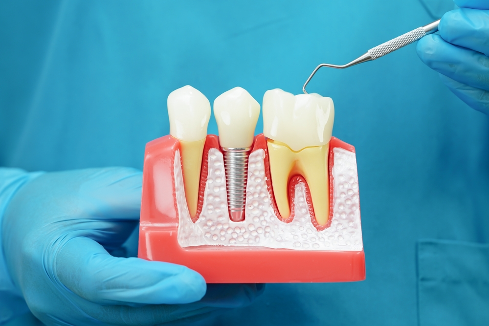 Dental Implants in Dacula GA | Affordable Tooth Replacement