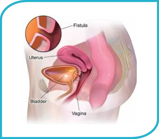 Laparoscopic VVF Repair (Vesicovaginal Fistula Repair)