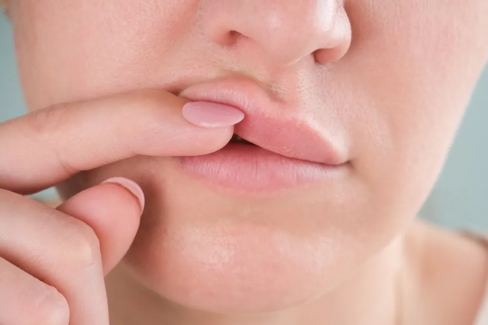 Filler Migration: Causes, Fixes & Prevention | Fontana & Encinitas