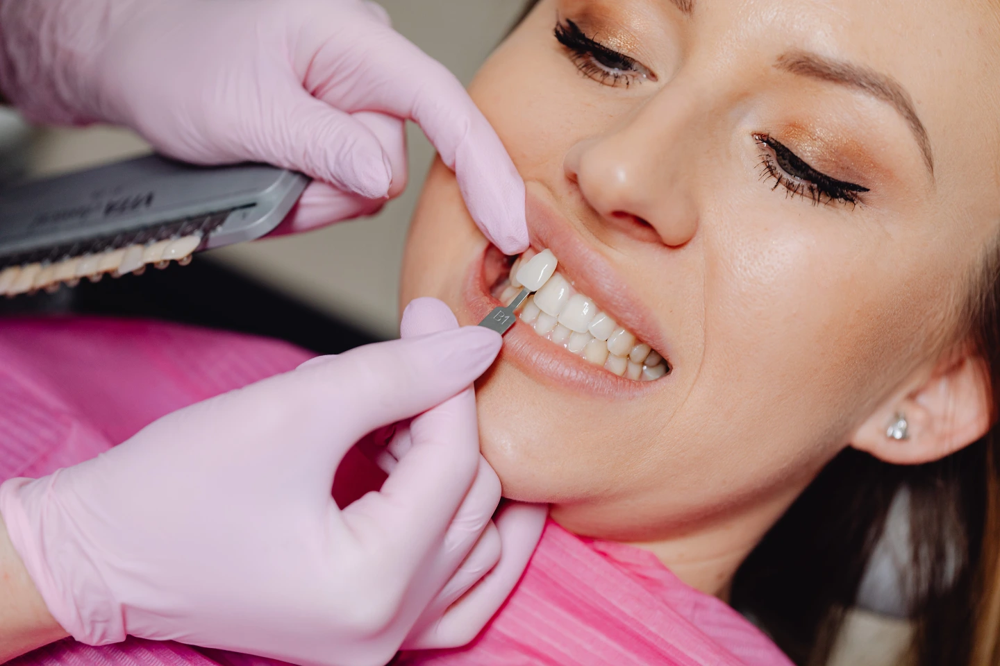How Long Do Front Tooth Crowns Last? Lifespan Guide