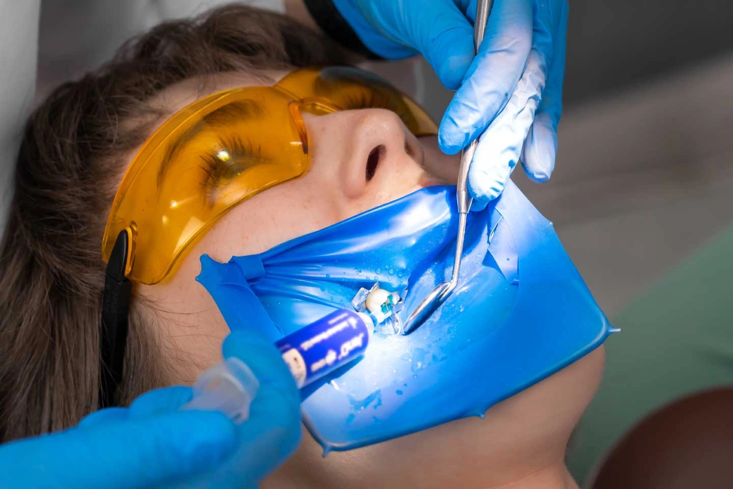 Should a Silver Dental Filling Always Be Replaced?